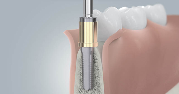 Zahnimplantate Implantation Schritt 2
