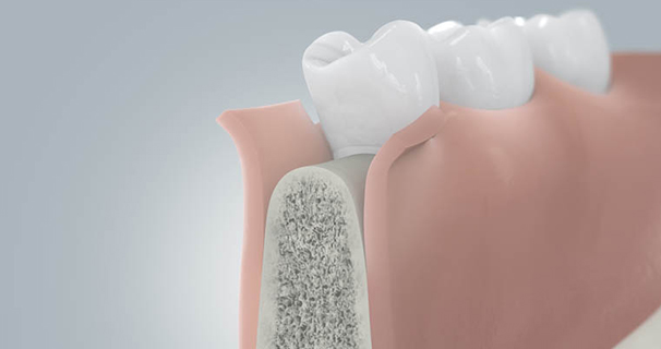 Zahnimplantate Implantation Schritt 1